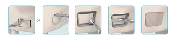1SinusLift.jpg
